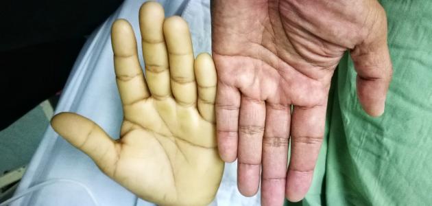 69 مليون عربي يعاني من سوء التغذية المسبب لفقر الدم 